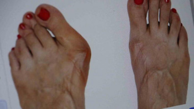 Topuklu ve sivri burun ayakkabı giyenler dikkat: Parmağınızın anatomisi bozulabilir